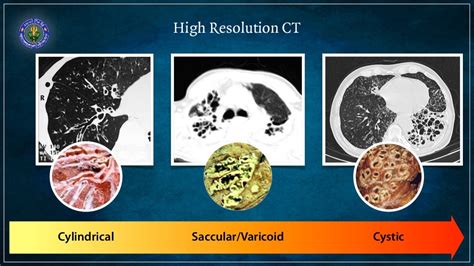 Bronchiectasis - causes and diagnosis