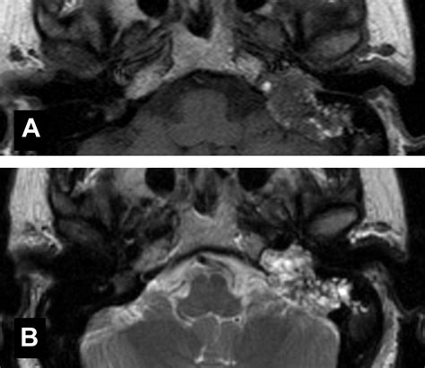 Nonparaganglioma Jugular Foramen Tumors Otolaryngologic Clinics Of