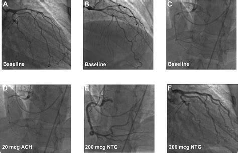 Coronary Artery Vasospasm Requiring Cardiac Autotransplantation Yet