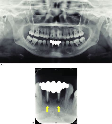 A Panoramic Radiograph Showing Extreme Resorption Of Alveolar Bone