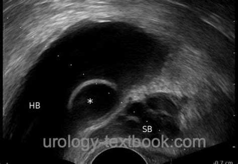 Ureterocele Symptoms Diagnosis And Treatment