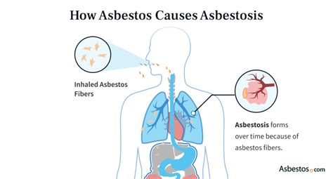 Asbestosis Overview: Causes, Symptoms, Treatment and More