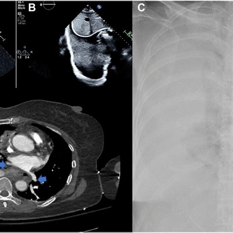 Hemothorax on Various Imaging Modalities | Download Scientific Diagram