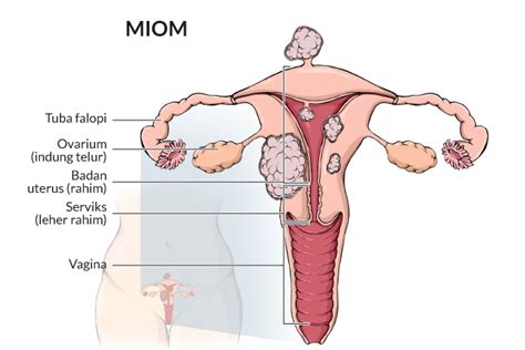 Miom Gejala Penyebab Dan Mengobati Alodokter