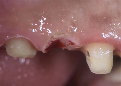 Dental Esthetics Ovate Pontic For The Correct Emergence Profile A