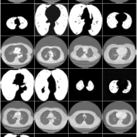 Several outputs of the snake algorithm for lung segmentation ...