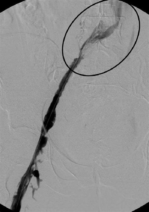 Digital Subtraction Left Iliac Venogram With Patient In The Prone