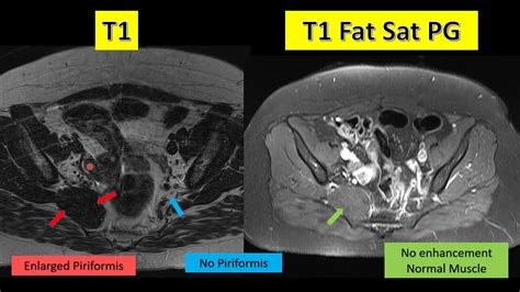 Piriformis Muscle Mri