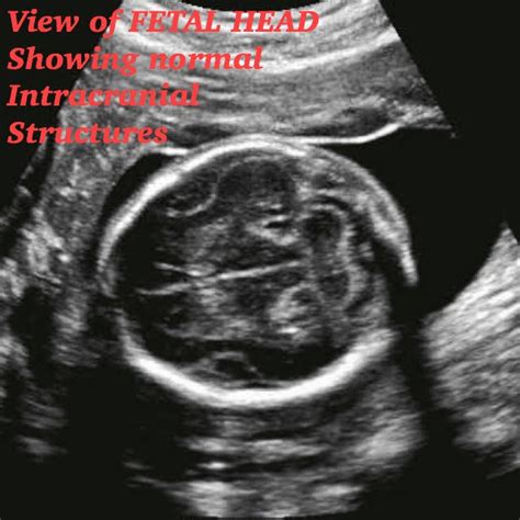 Normal 22 week baby ultrasound. - Ultrasoundfeminsider