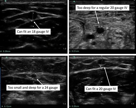 Us Iv Selection Pocus Pro And