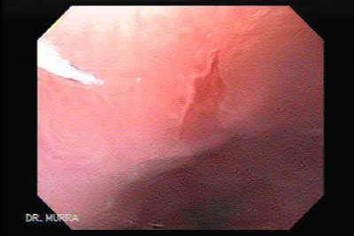 Barrett S Esophagus Ii The Gastrointestinalatlas