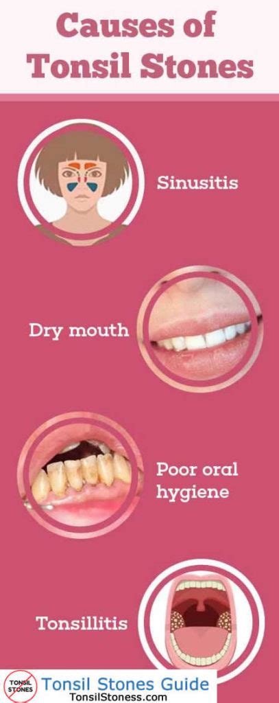 What Causes Tonsil Stones? [2022]