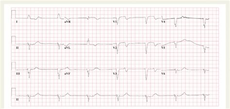 Complete Atrioventricular Block With A Ventricular Escape Rhythm Of 40