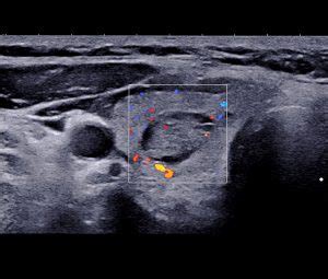 Imagerie De La Thyro De L Institut De Radiologie De Paris