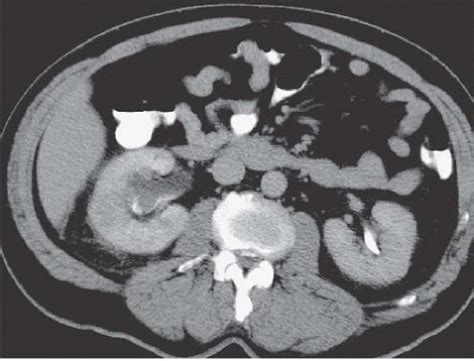 Pelvicalyceal System and Ureter | Radiology Key