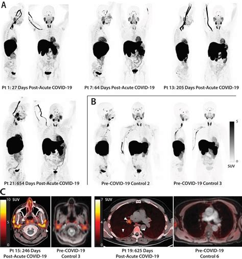 Los Pacientes Con Long Covid Conservan Arn Viral Durante A Os