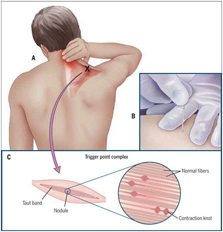 Trigger Point Dry Needling | Physical Therapy Arlington & McLean VA