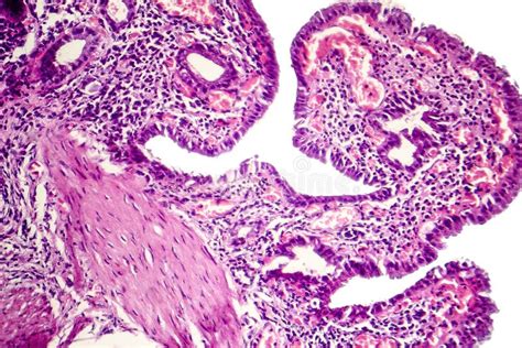 Cholecystitis Histology