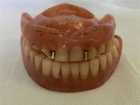 A 5 Week Non Surgical Approach Towards Denture Induced Hyperplasia