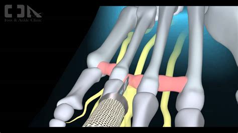 Minimally Invasive Mortons Neuroma Surgery Youtube