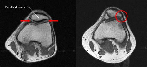 Patellofemoral Pain Syndrome Orthoinfo Aaos