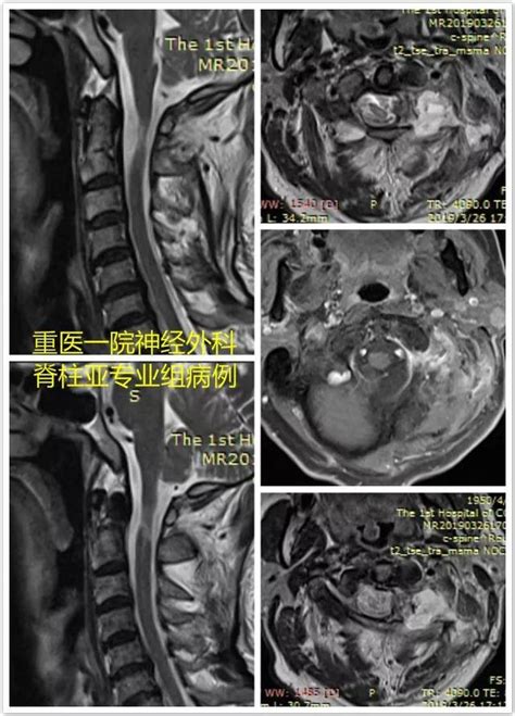 病例分享 頸側方入路切除c12溝通腫瘤 每日頭條