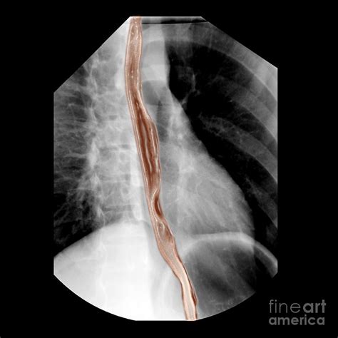 Normal Esophagus 1 Photograph By Living Art Enterprises Pixels