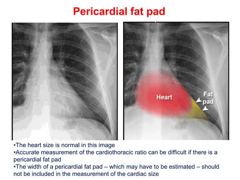 Chest X Ray Cardiac Diseasepptx Free Download