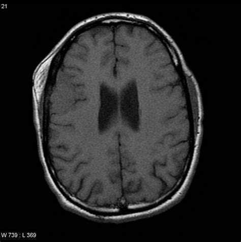 Radiopaedia Case Meningioma With Extension Through Skull Vault Id