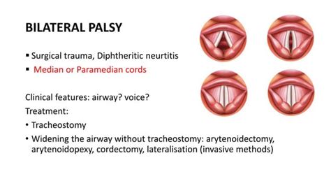 Vocal cord palsy | PPT