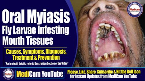 Oral Myiasis Infesting Mouth Tissues Causes Symptoms Diagnosis And