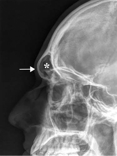 Neuroradiology In Transgender Care Facial Feminization Laryngeal