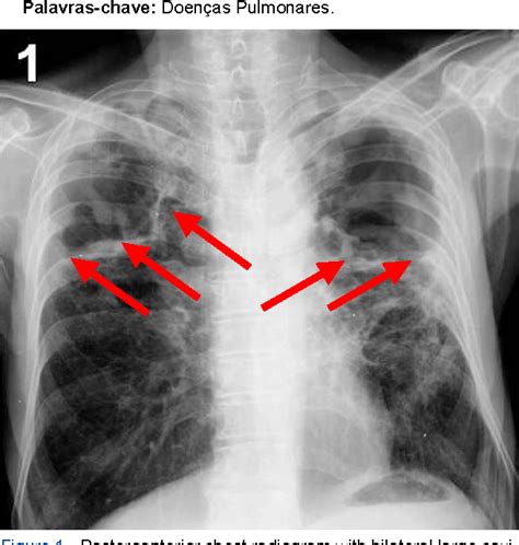 Figure 1 from Cavitary lung lesions. | Semantic Scholar