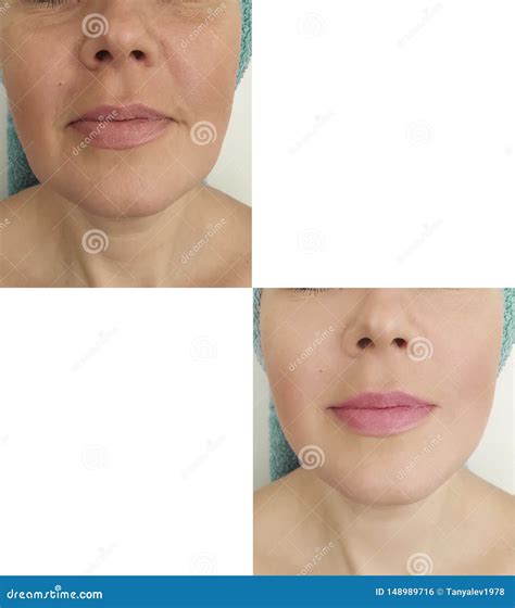 Woman Face Wrinkles Before And After Correction Stock Photo Image Of