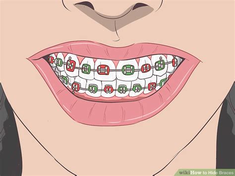 How To Draw Braces On Teeth Easy Warehouse Of Ideas