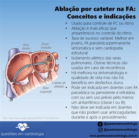 Ablação Por Cateter Na Fibrilação Atrial Conceitos E Indicações