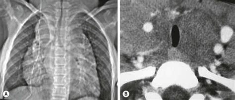 Mediastinal Tumors | Clinical Gate