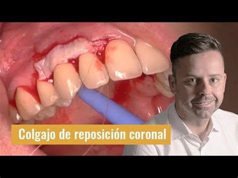 Colgajo de reposición coronal múltiple mediante técnica de abordaje