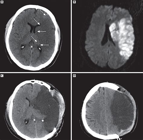 Infarto Cerebral Maligno Medical Gabeents