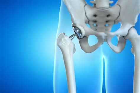 Hip Arthroscopy Vs Total Hip Replacement Procedure and Benefits ...