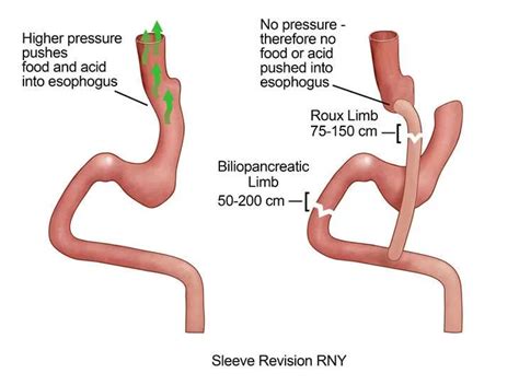 Acid Reflux After Gastric Sleeve Conversion To Bypass An Effective Solution