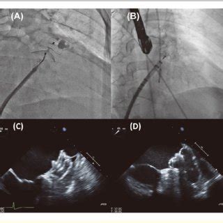 Representative Intra Procedural Fluoroscopy Right Anterior Oblique