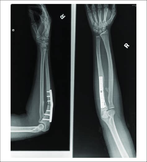 AP and lateral X-rays of elbow after open reduction and internal... | Download Scientific Diagram