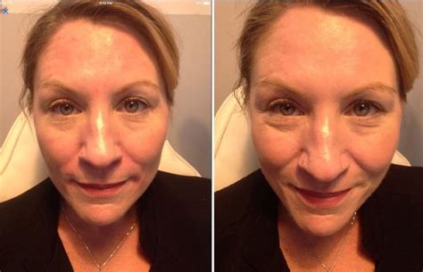 Botox In The Forehead And Dermal Filler Nasolabial Fold Beautiful