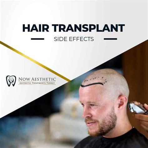 Hair Transplant Side Effects - Now Aesthetic