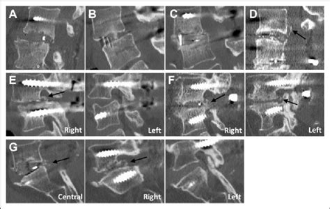 Examples Of Ossification Grades At The Sagittal View A Grade 0 No Download Scientific