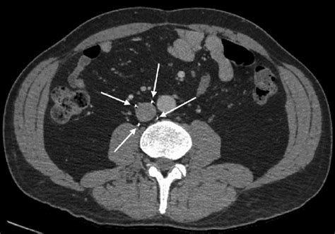 B Single Slice Axial Contrast Enhanced Ct Image Of The Abdomen At The