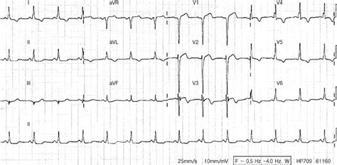 Electrocardiography Showed Normal Sinus Rhythm With Delta Waves