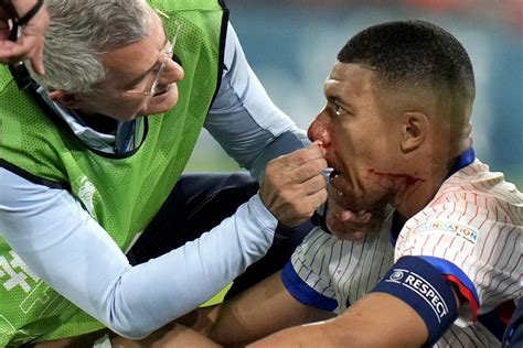 Euro Broken Nose Inhibits Mbappes Form As France Advances Into