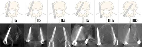 Visual Representation Of Pedicle Screw Placement Grading System Download Scientific Diagram